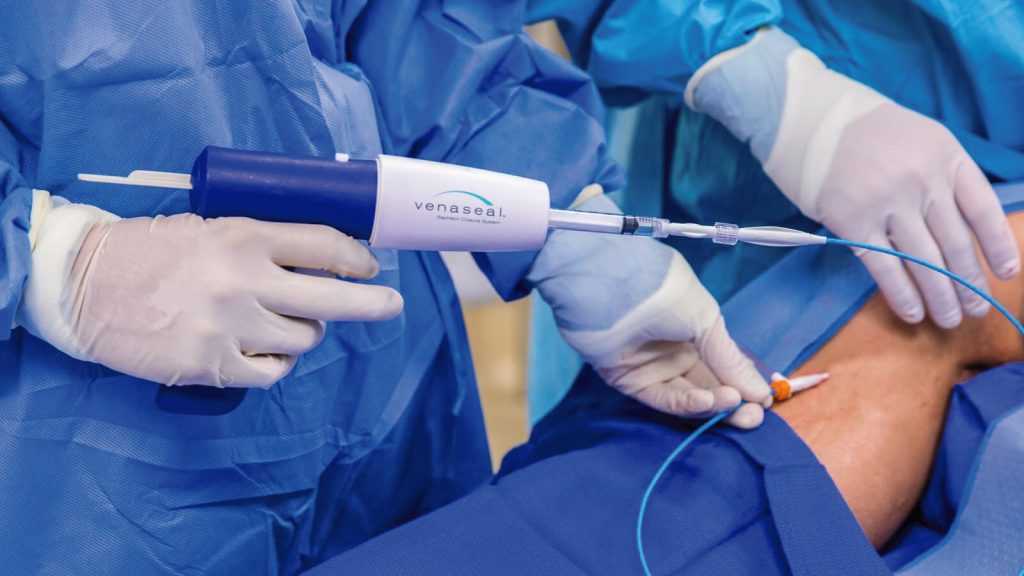 Sistema Venaseal para eliminar varices sin cirugía