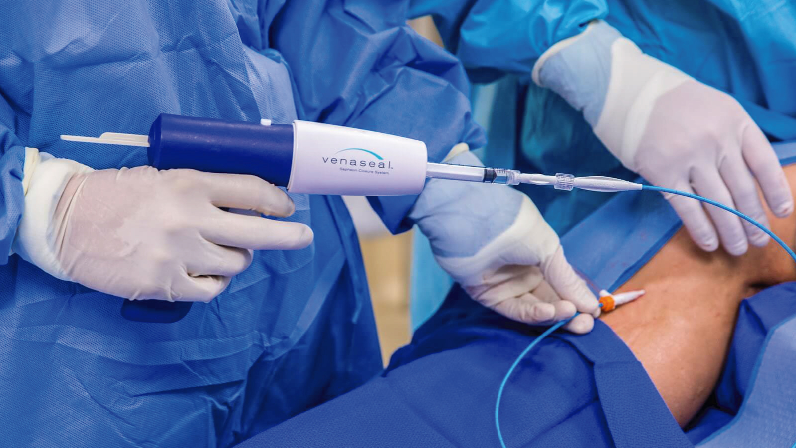 Sistema Venaseal para eliminar varices sin cirugía