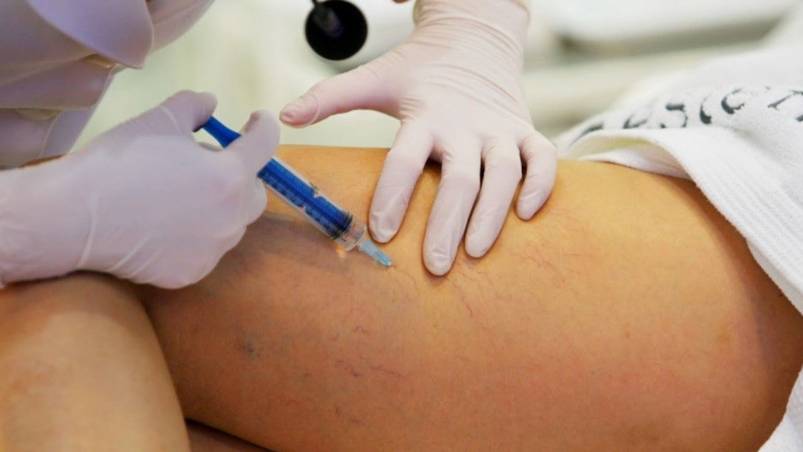 Sellado con cianoacrilato para varices, novedoso y poco invasivo