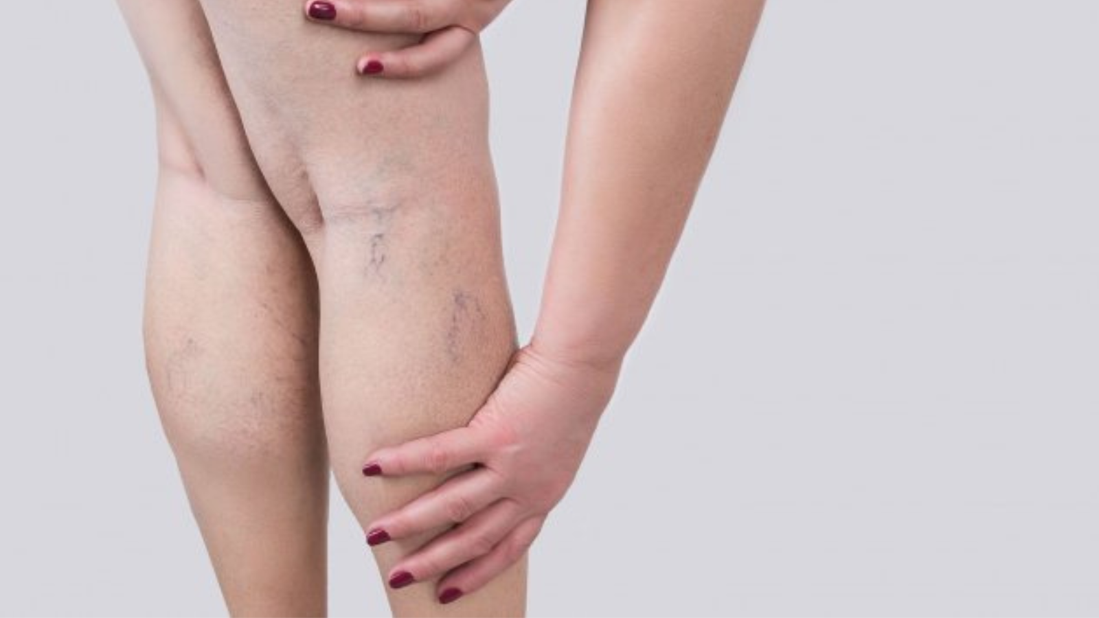 Varices en hombres y mujeres: diferencias y similitudes