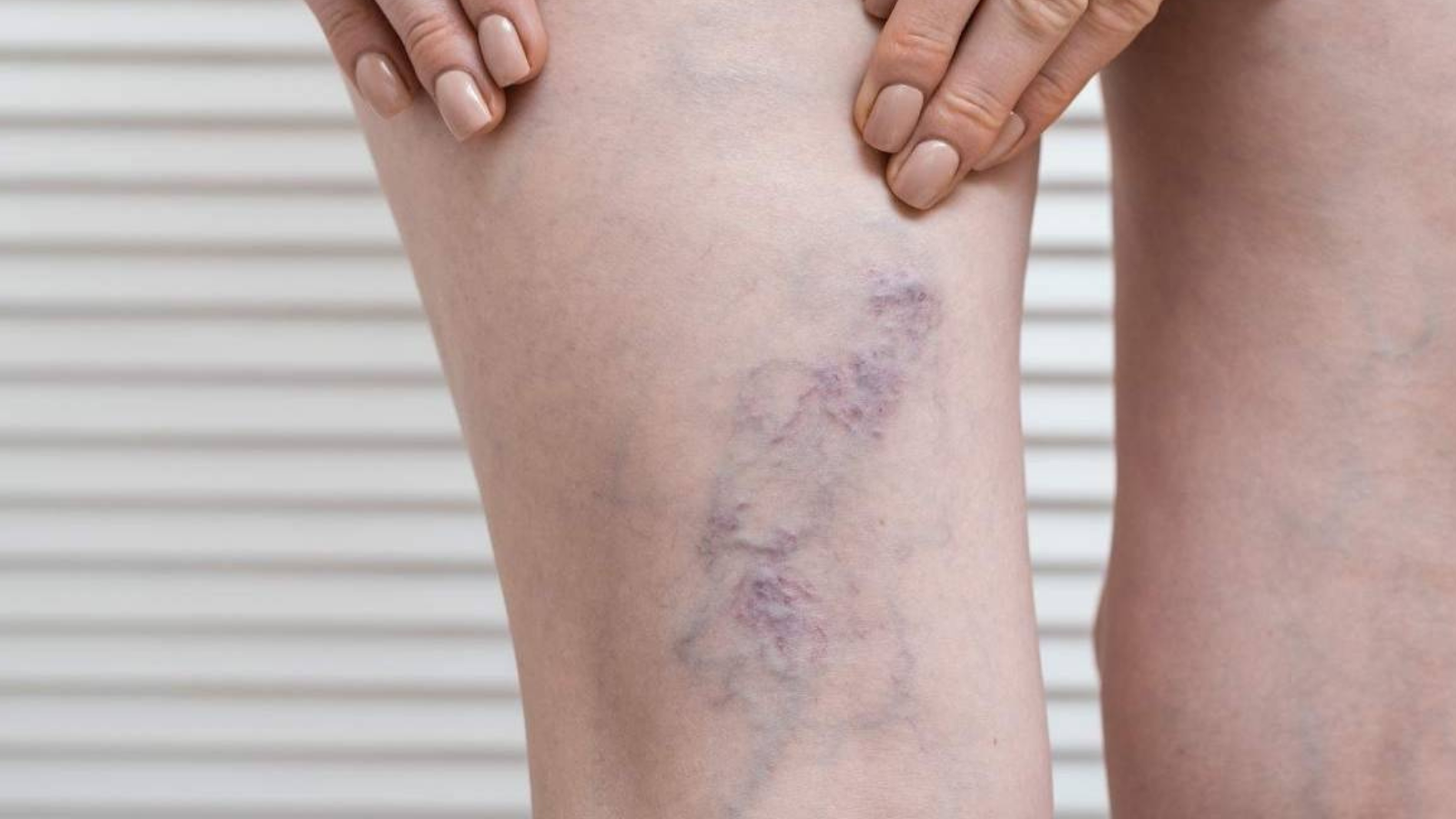 Úlcera arterial vs úlcera venosa, ¿en qué se diferencian?