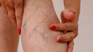 Insuficiencia venosa, ¿qué significa el color de tus venas?