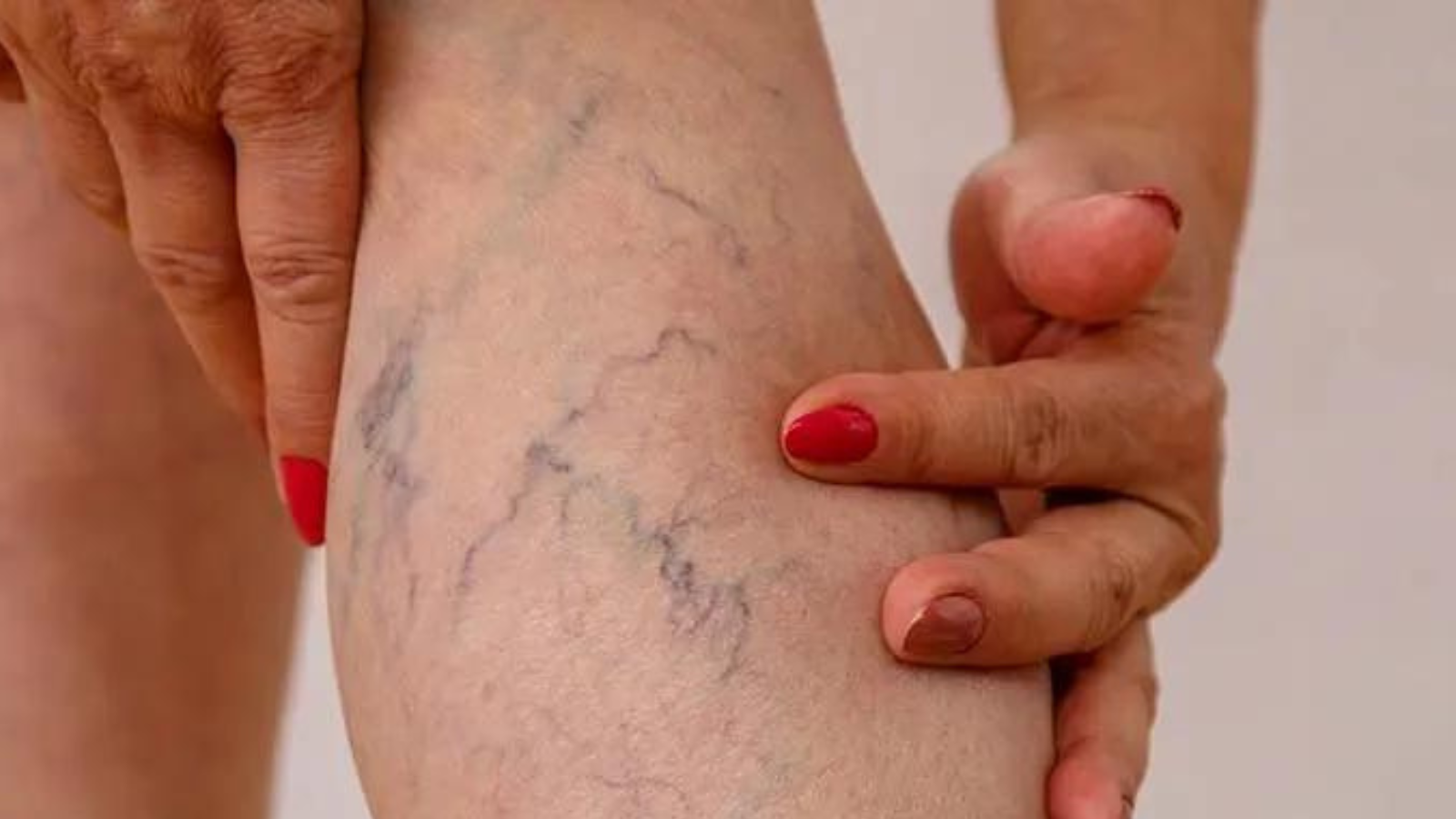 Insuficiencia venosa, ¿qué significa el color de tus venas?