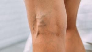 ¿Se puede producir una ruptura de venas varicosas?