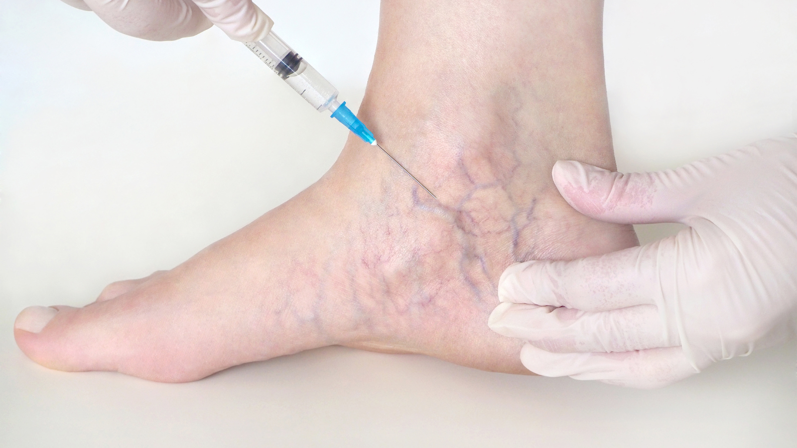 Quiénes son los candidatos ideales para los tratamientos de varices